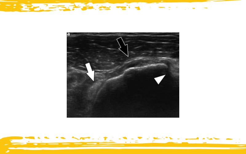 Manguito rotador tempo formacion 4.jpg